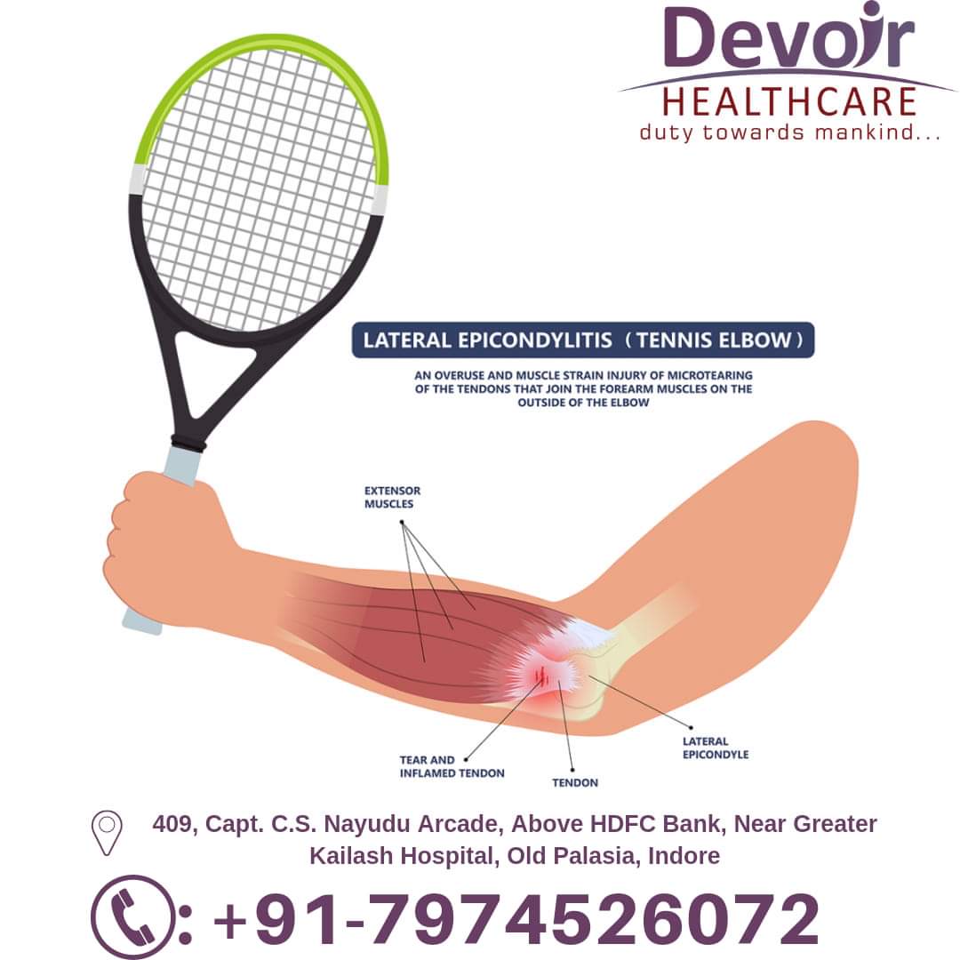 #Tenniselbow, or lateral epicondylitis, is a painful condition of the elbow caused by overuse. 

Book an appointment: 079745 26072 

#devoirhealthcare #painrelief #rehabilitation #PMR #painmanagement #painmedicine #healthcare #Indore #bestpainphysician #paindoctor #elbowpain