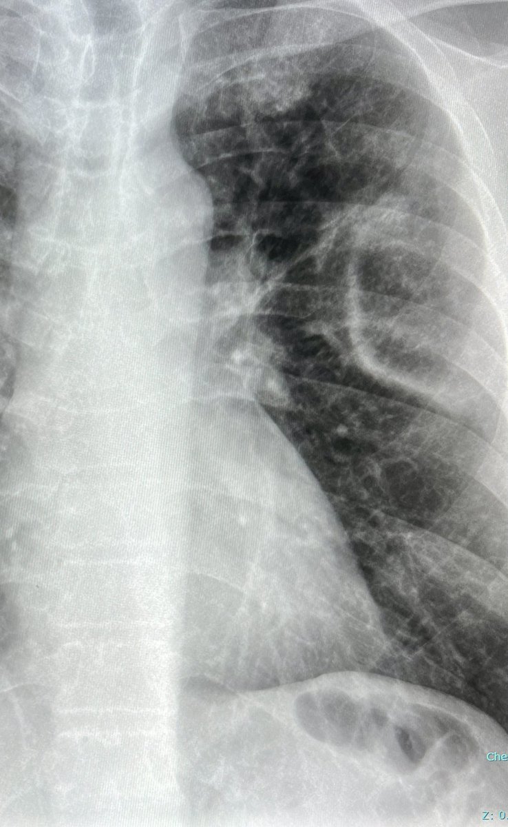 “Photographic negative of pulmonary edema”- a classical radiographic pattern of chronic eosinophilic pneumonia —classic cases on-call