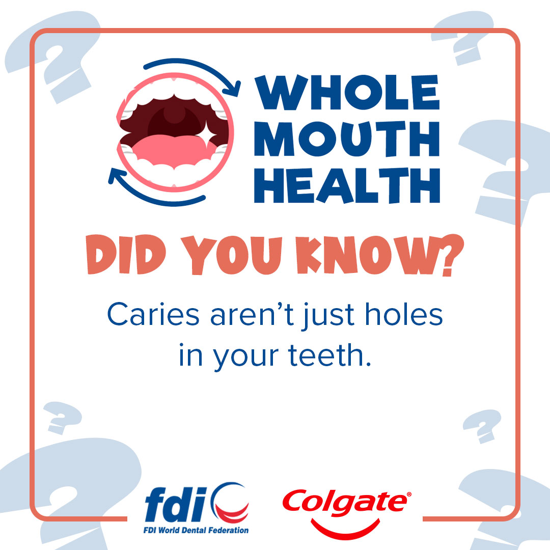 #DidYouKnow ❓ Caries aren’t just holes in your teeth. It is thought that dental caries is an infectious bacterium that can be transmitted between people – particularly between nursing mothers and their babies. Learn more with the #WholeMouthHealth tool⬇️ fdi.ngo/3AS4RK3