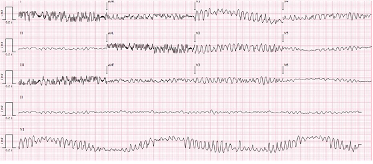 1/2
Are your ready for a Monday challenge? - new #EHJACVC #SpotTheDiagnosis is out 
Check out the case 👉academic.oup.com/ehjacc/advance…

#ACVC_ESC #cvacute 
@EHJACVCEiC @drmilicaa @ACVCPresident @maria_bergami @ann_oleksiak