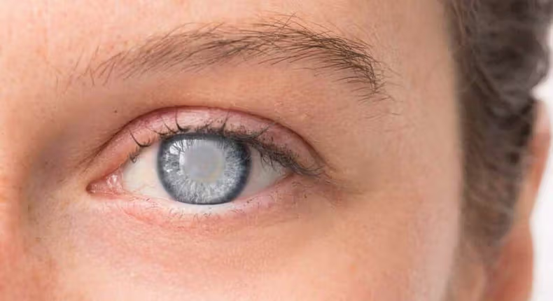 Cataracts: Causes, symptoms, treatments, and prevention bit.ly/3y7b8EQ