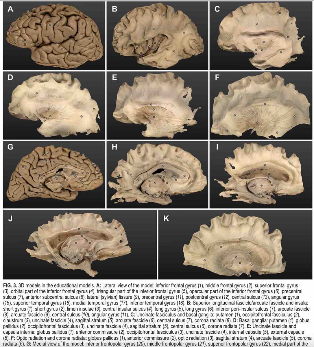 #OnlineFirst: Creating a neuroanatomy education model with augmented reality and virtual reality simulations of white matter tracts. thejns.org/view/journals/…