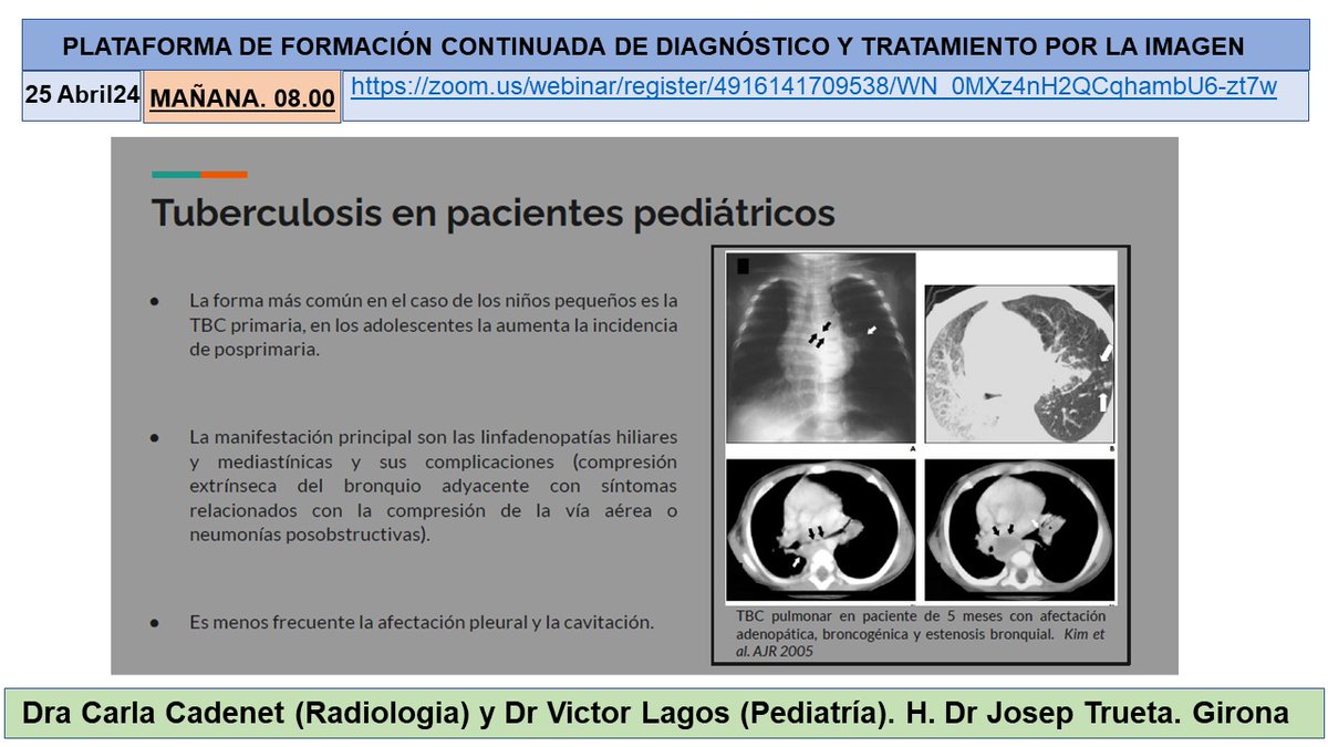 Great lecture by by Dra. Carla Cadenet (Rad) and Dr. Victor Lagos (Pedia) about “Pulmonary Tuberculosis in Pediatrics' with moderation from Dra Noemí Cañete... @hospitalclinic @SEICAT_RAD @SE_Rad_Ped @idibgi @Radiolegs_CAT @seram_rx @iasgirona @AreaHjt @myESR @RSNA