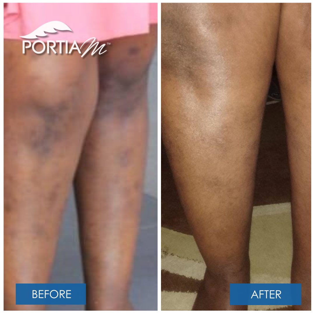 Thank you for trusting us with your skin. 🍃✨✨

Products used : Marula oil and Body Lotion 

#beforeandafter
#portiamskincare 
#sharetheglow🍃

📸 Mhayise Nontando