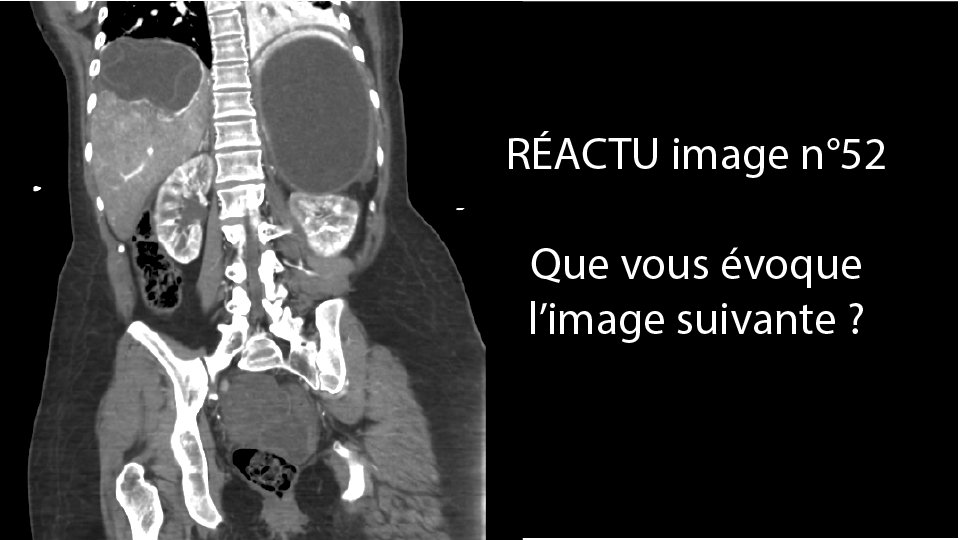 RÉACTU-IMAGE N°52 Patiente originaire du Maroc, présentant une hydatidose disséminée sous Albendazole depuis 4 semaines, est prise en charge pour douleurs du flanc droit puis ACR sur asystolie. Que retrouvez-vous sur le scanner ? Ici le cas complet📍🔗zurl.co/gEcI