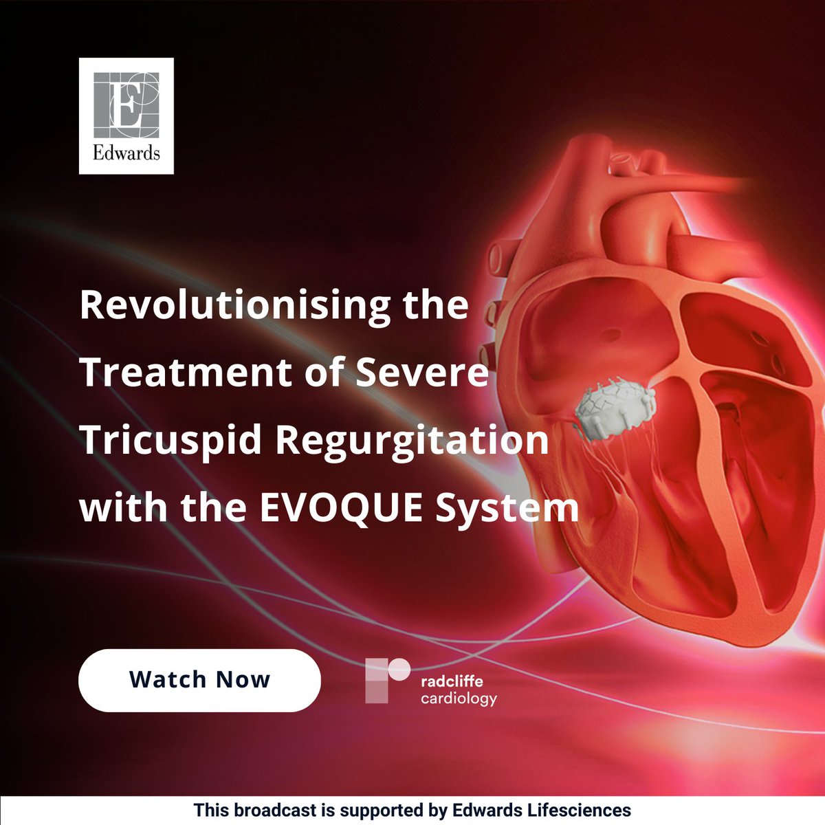 Gain insights into the #EVOQUE system with this insightful broadcast on demand!🌟 ow.ly/vg9J50RmilE 📊Uncover how the EVOQUE system has the potential to eliminate TR ✅Learn about the patient selection criteria and the latest clinical evidence #TTVR #Tricuspid #TTVI