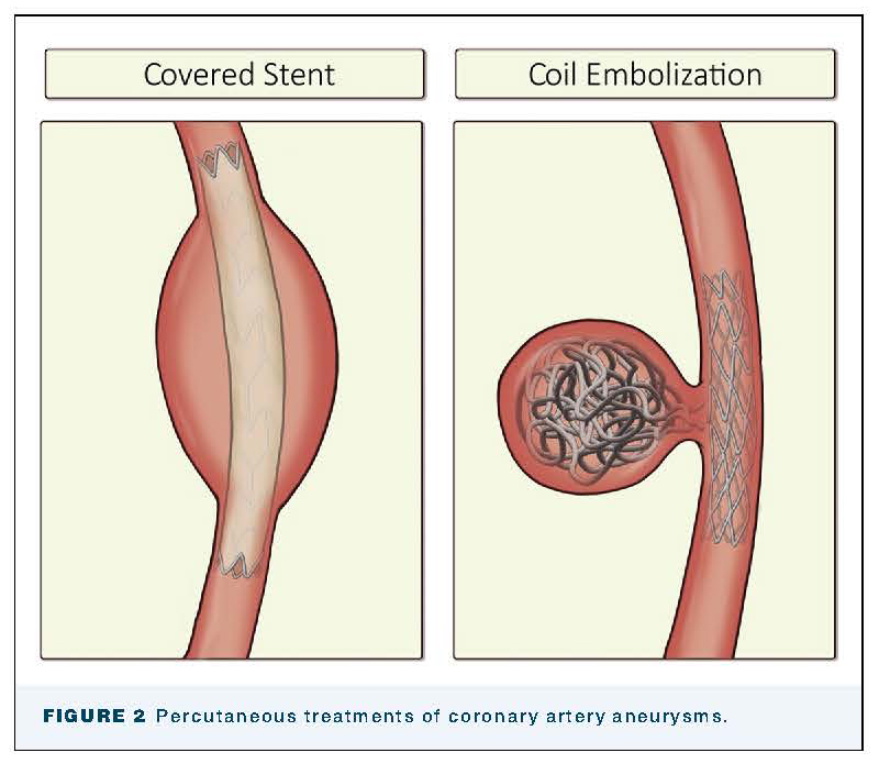 #EditorsChoice This expert review from Dimagli, Gaudino, and coauthors describes the evidence and techniques for the surgical management of coronary artery aneurysms, coronary arteriovenous malformations, and spontaneous coronary artery dissections 👇
doi.org/10.1016/j.atho…