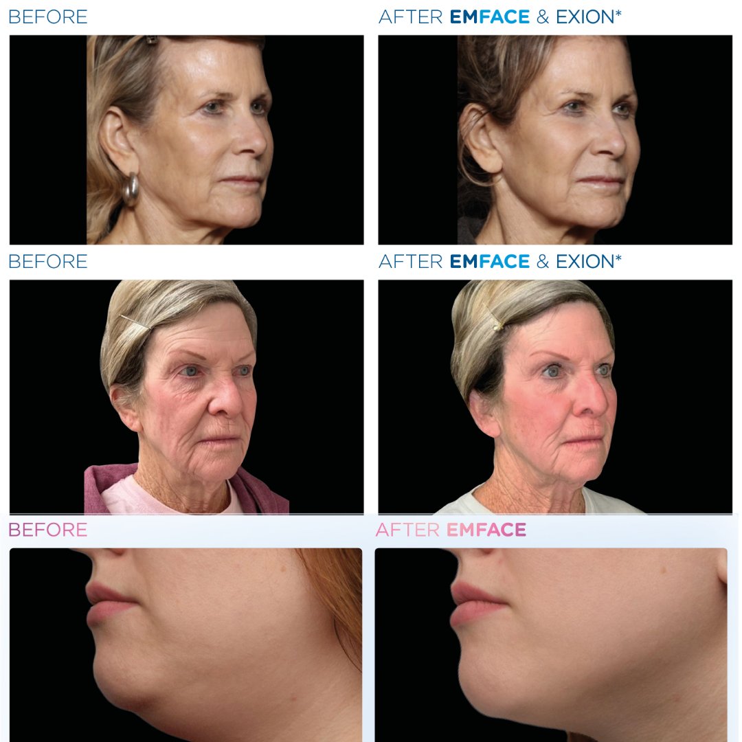 🌟 Exciting Transformations with Emface & Exion! 🌟
THe incredible before and after results using Emface and Exion Speak for themselves! 😱🌟
💬 Have you tried Emface or Exion?