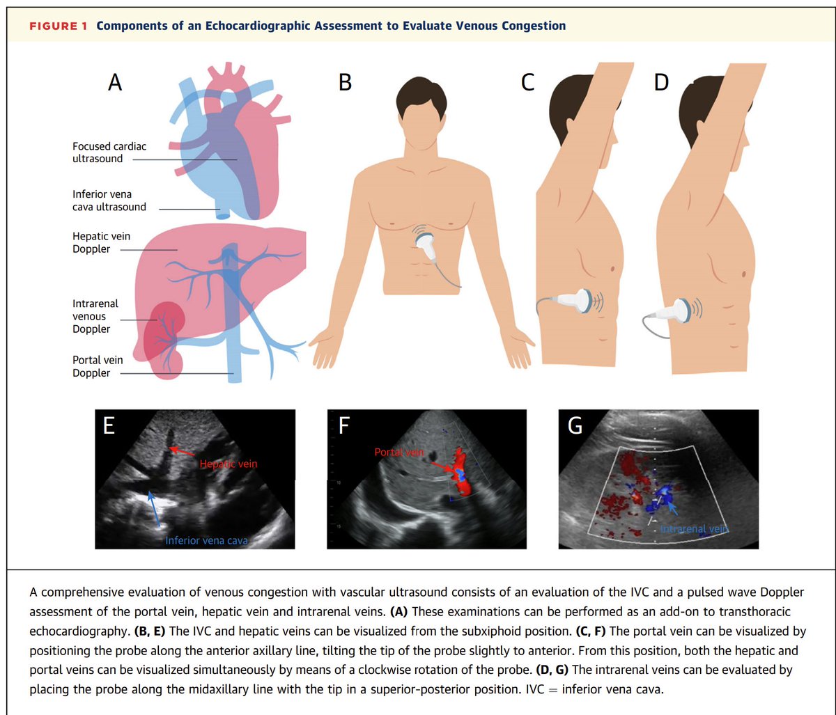 IMAGING VIGNETTE Assessment of Venous Congestion Using Vascular Ultrasound AN ACCURATE ASSESSMENT OF THE VENOUS PRESSURE IS CRUCIAL TO OPTIMIZE FLUID MANAGEMENT IN patients with heart failure. doi.org/10.1016/j.jcmg… sciencedirect.com/journal/jacc-c…