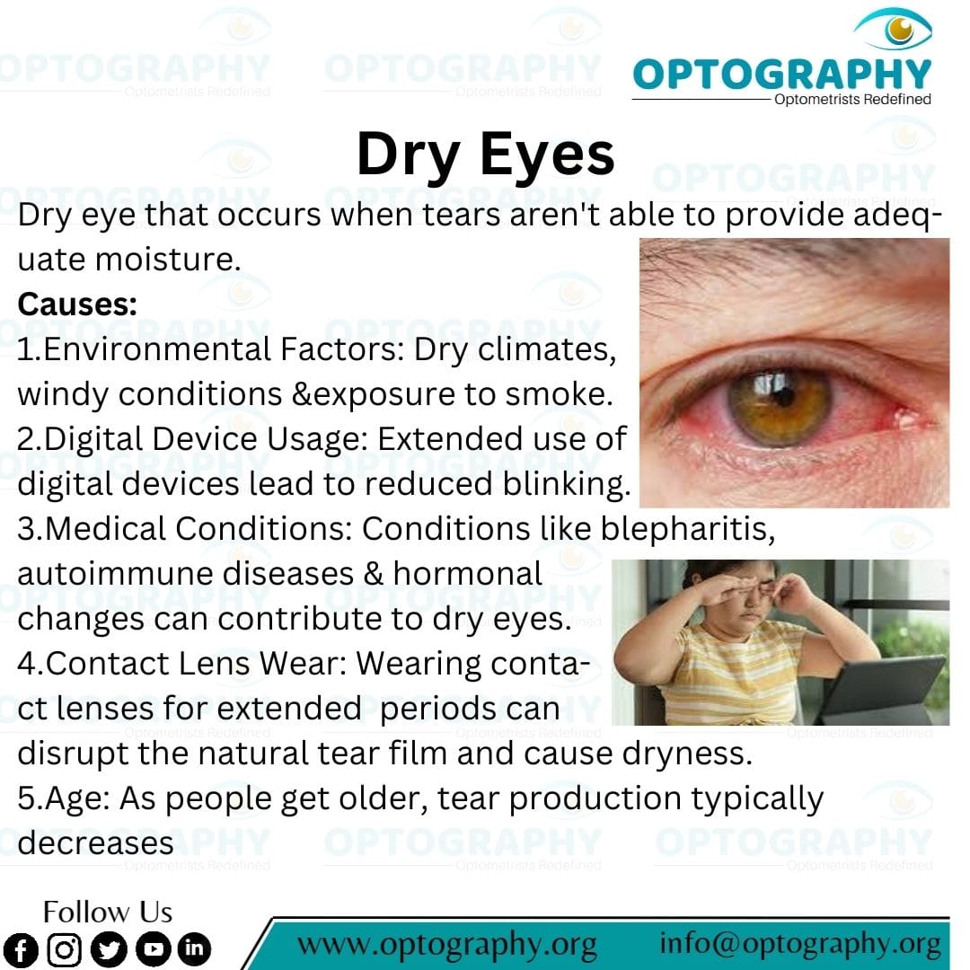 Peeling Back the Layers: Delve into the World of Dry Eye Syndrome. Understand the Causes Behind the Irritation and Discomfort Experienced by Many.
#Optography #Optometrist 
#Dryeyes #Dryness
#contactlens
#Optometry