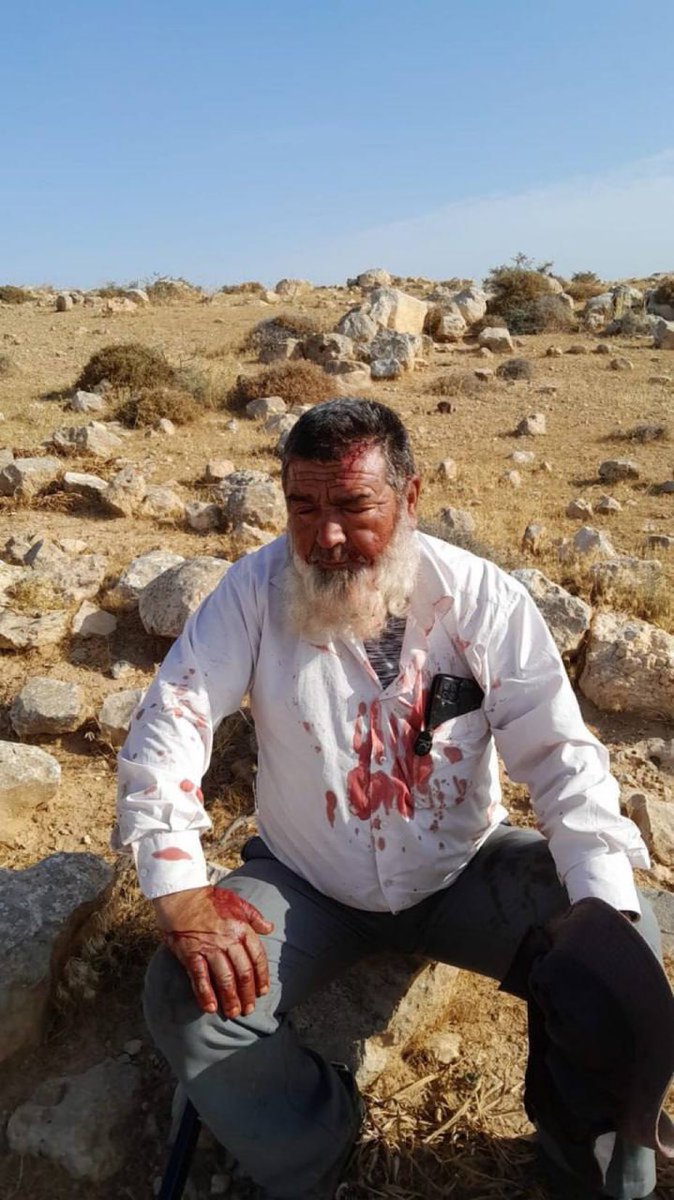 Naeem Hamamdeh, an elderly Palestinian from the Masafer Yatta region, south of occupied Hebron, suffered bruises and cuts this morning in a racially motivated attack by Israeli settler militias near his home.