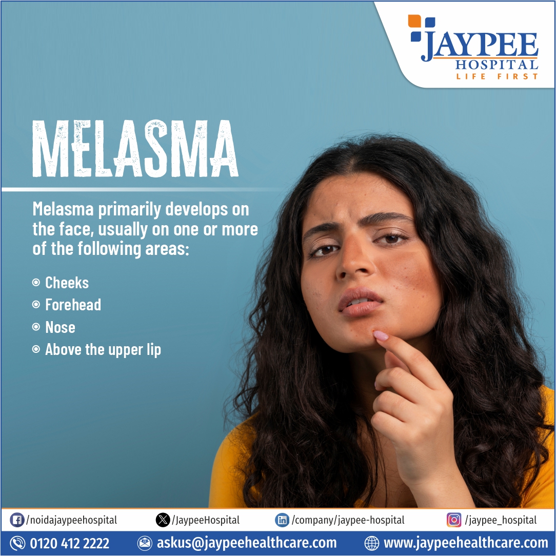 Pigment on face? It can be Melasma

#Pigment #Face #Melasma #Skincare #Sunspots #Hyperpigmentation #Beauty #SkinIssues #TreatmentOptions #Dermatology #Cosmetics #SunProtection #SkinCareRoutine #HealthySkin #EvenSkinTone #SunDamage