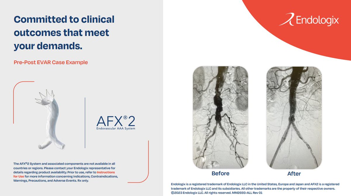 With the AFX2 System, overcome challenges in specific anatomies. The bifurcated unibody design preserves the natural bifurcation. Explore a Pre and Post #EVAR case example here: endologix.com/aaa/afx2/ #AFX2 #LEOPARDRCT #AAA RX Only. ISI: endologix.com/import-safety-…