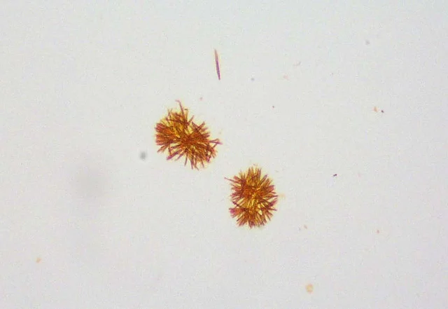 lifeofamedtech's tweet photo. Abnormal Urine Crystals associated with L𝗜VER DISEASE

Mnemonics: "𝗕i𝗟a𝗧 𝗟o𝗩𝗘𝗥"
A. 𝐁𝐢𝐥𝐢𝐫𝐮𝐛𝐢𝐧
B. 𝐋𝐞𝐮𝐜𝐢𝐧𝐞
C. 𝐓𝐲𝐫𝐨𝐬𝐢𝐧𝐞
= 𝐋𝐈𝐕𝐄𝐑 https://t.co/4nwgsb8AuS