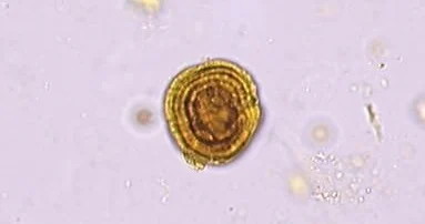 lifeofamedtech's tweet photo. Abnormal Urine Crystals associated with L𝗜VER DISEASE

Mnemonics: "𝗕i𝗟a𝗧 𝗟o𝗩𝗘𝗥"
A. 𝐁𝐢𝐥𝐢𝐫𝐮𝐛𝐢𝐧
B. 𝐋𝐞𝐮𝐜𝐢𝐧𝐞
C. 𝐓𝐲𝐫𝐨𝐬𝐢𝐧𝐞
= 𝐋𝐈𝐕𝐄𝐑 https://t.co/4nwgsb8AuS