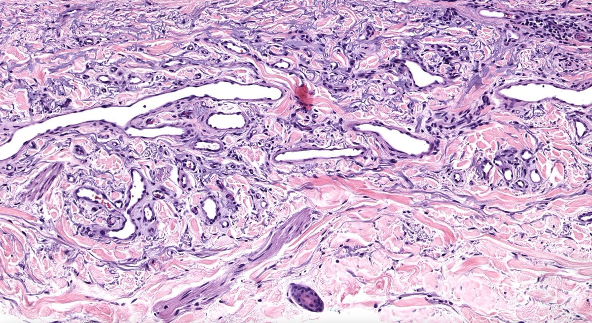 60 F with red plaque on dorsal forearm.
WSI digital slide: kikoxp.com/posts/8022 
Clinical pics: kikoxp.com/posts/8023 
Answer & video: kikoxp.com/posts/10074 
#pathology #pathologists #BSTpath #pathTwitter #dermpath #dermatology #dermatologia #dermtwitter