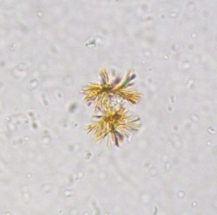 lifeofamedtech's tweet photo. Abnormal Urine Crystals associated with L𝗜VER DISEASE

Mnemonics: "𝗕i𝗟a𝗧 𝗟o𝗩𝗘𝗥"
A. 𝐁𝐢𝐥𝐢𝐫𝐮𝐛𝐢𝐧
B. 𝐋𝐞𝐮𝐜𝐢𝐧𝐞
C. 𝐓𝐲𝐫𝐨𝐬𝐢𝐧𝐞
= 𝐋𝐈𝐕𝐄𝐑 https://t.co/4nwgsb8AuS