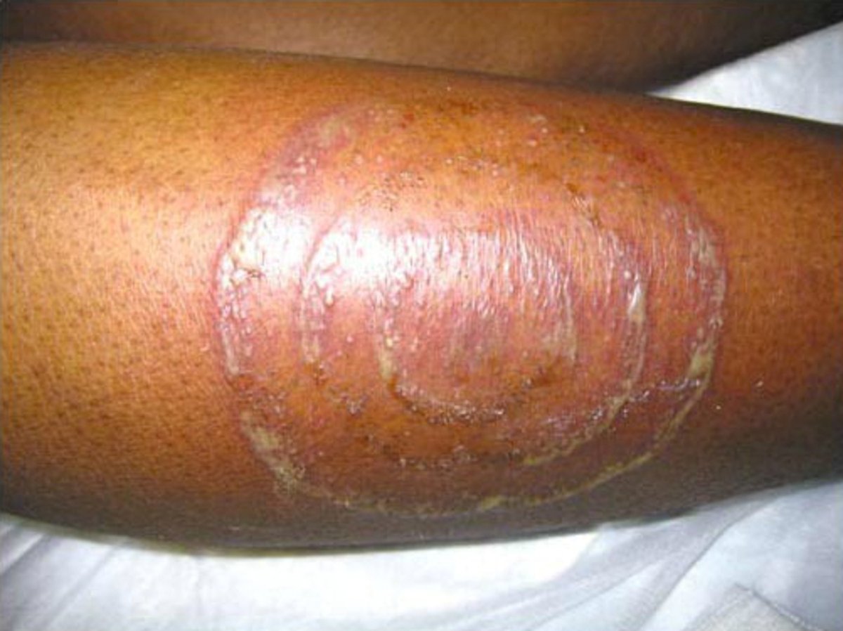 A 46 y/o woman with HIV infection presented with a painful rash on pretibial surface of the right leg. The patient reported having been scratched by a cat in the same area three weeks earlier. - What’s the diagnosis ? ➡️ Answer: manualofmedicine.com/spot-diagnosis… #medtwitter #foamed