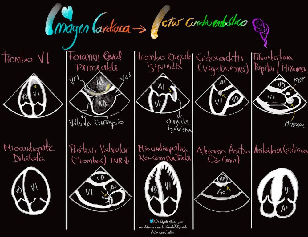 Repaso de la Infografía creada por Alania @ed_alania
Ictus cardioembólico
📊 buff.ly/3UAwOlQ ◀️