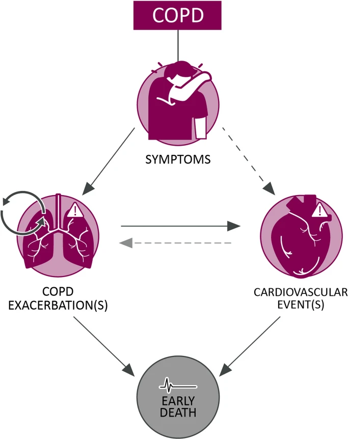 Implications of #Cardiopulmonary Risk for the Management of #COPD: A Narrative #Review Read the full #openaccess review here 🗒️: link.springer.com/article/10.100… #cardiology #respiratory #lungs