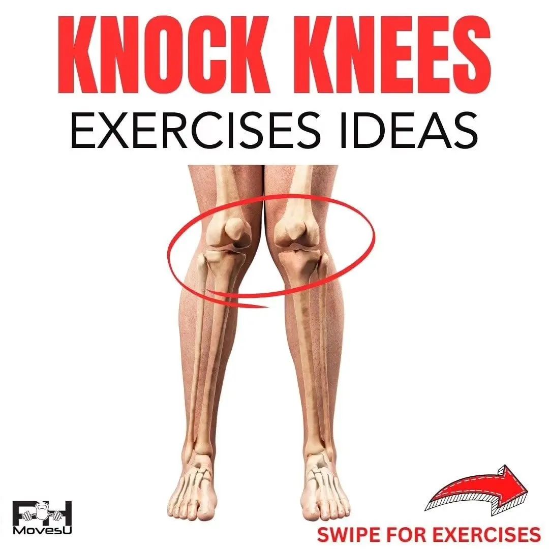 Knock Knees Exercise Ideas.