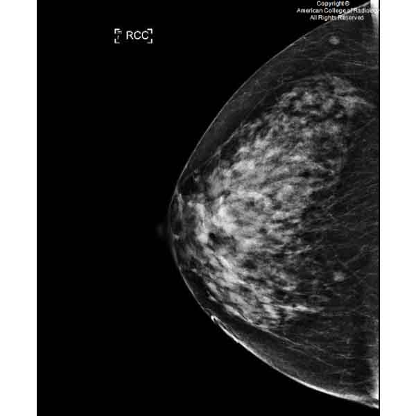 A 65-year-old woman with a history of heterogeneously dense breasts presents for her annual bilateral screening mammogram. #ACRCaseinPoint bit.ly/4b3sfpG
