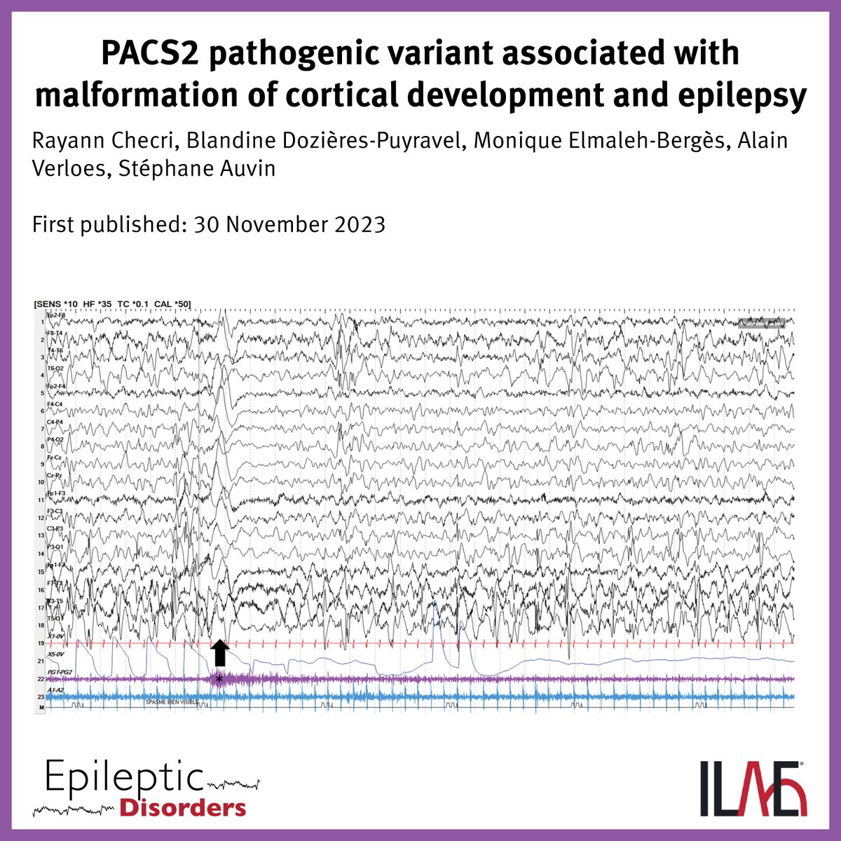 Key point: 'PACS2 pathogenic variants are associated with an autosomal dominant syndrome developmental and epileptic encephalopathy including cerebellar dysgenesis.' @EpiDisorders: doi.org/10.1002/epd2.2… #epilepsy #epilepsyresearch @WileyNeuro