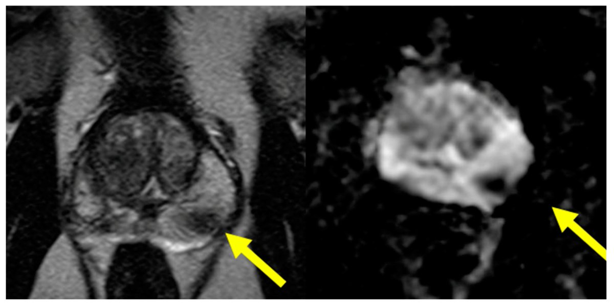 🏥 Read 'MRI-Ultrasound Fused Approach for #Prostate Biopsy-How It Is Performed,' recent work from @JacobLang1996, @DoctorMargolis, & @TimMcClureMD in @Cancers_MDPI via @MDPIOpenAccess, here 👉 tinyurl.com/5y7kcstz