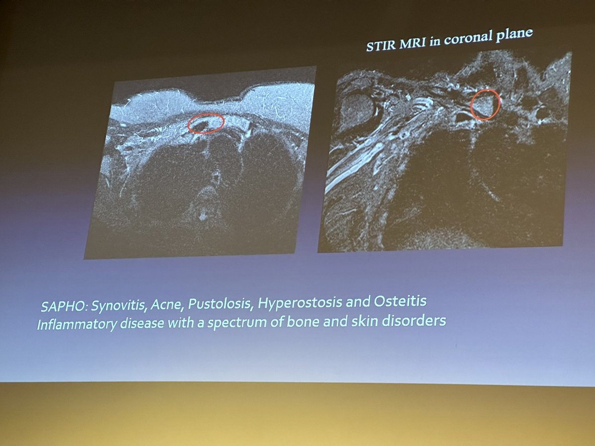 Msk findings on chest CT

-  hyperostosis at the costochondral junction, think SAPHO syndrome!

Great talk by Dr Emma Rowbotham
@EmmaRowbotham2 @BSTImaging 
#bsti #foam #radres #foamrad