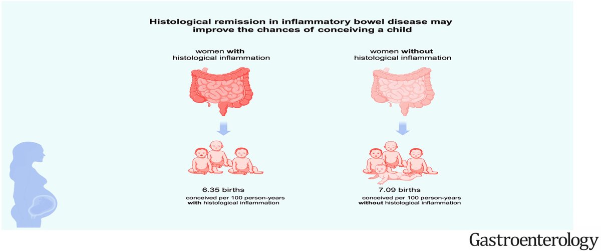 Histologic Remission in #IBD and Female Fertility: A Nationwide Study ➡️ ow.ly/sz0Q50RnsRw