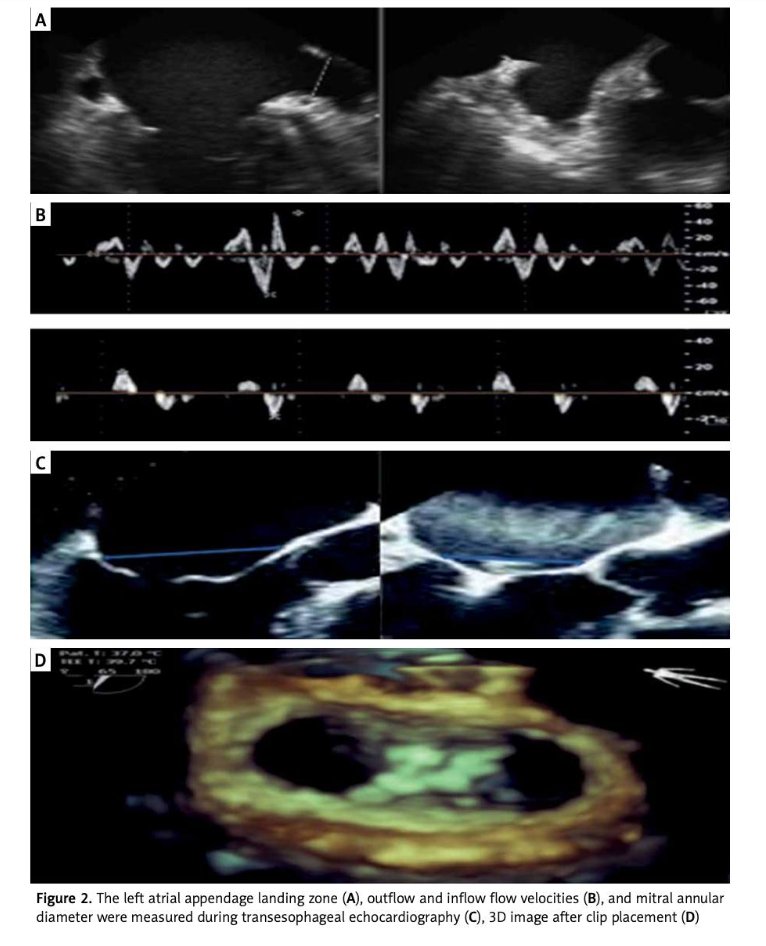 The MitraClip system has been shown to provide low peri-procedural complication rates, a significant reduction in mitral regurgitation (MR) with mortality benefits, improved functional capacity, and improved quality of life in high-surgical-risk patients   termedia.pl/EMCAPT-study-t…