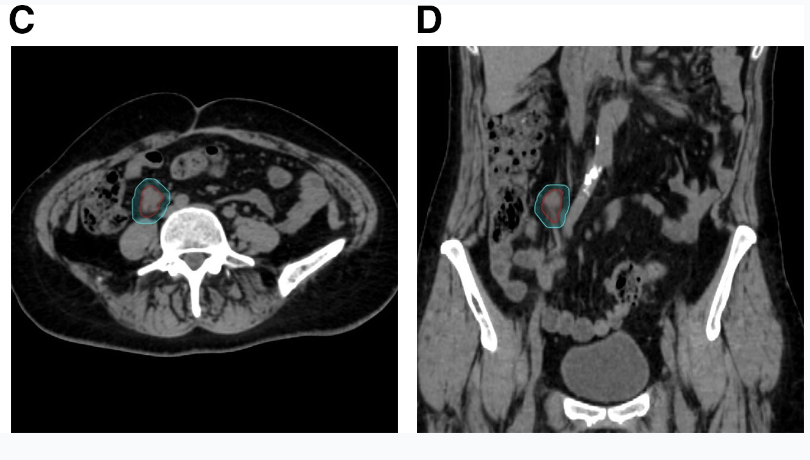 Planning Target Volume Margin Assessment of Retroperitoneal Tumors Using Robotic SBRT With Spine Tracking

Read more ➡️ bit.ly/3PPdiPt
@grantmckenz
#RadOnc #RadOncEd #RadOncRes #SRS #Oligomets