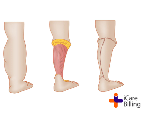 Lymphoedema is a chronic  condition that causes swelling in the body's tissues. It can affect any part of the body, but usually develops in the arms. Other symptoms of lymphoedema can include an aching, heavy feeling in affected body parts.   
#icarebilling, the best #RCM Company