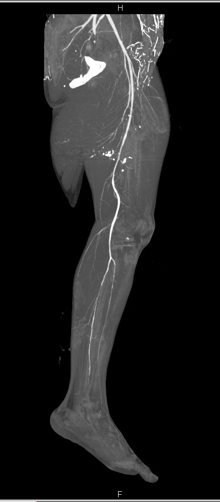 Femur Fx without Vascular Injury and VRT