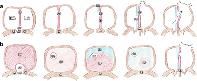 Coronary CTで見られる冠動脈病変以外の心疾患を理解するために。
卵円孔開存とASDのCT像を理解するのに発生が必要。この図と論文よかったので、おすそ分けします。
insightsimaging.springeropen.com/articles/10.10…
