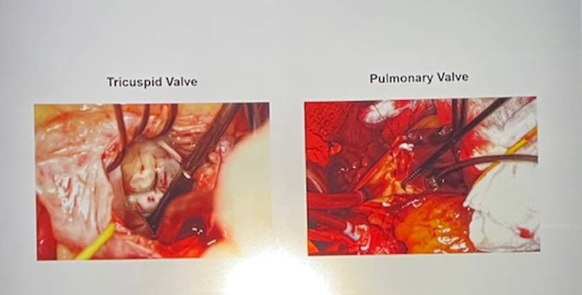 Interesting cases shared by @JaeKOh2 @RMankadMD & S. Allen Luis, MD @MayoClinicCV Echo Board Review Course! This specific one was an incredible collaboration w/ cardiac surgeon @JuanCrestanello!