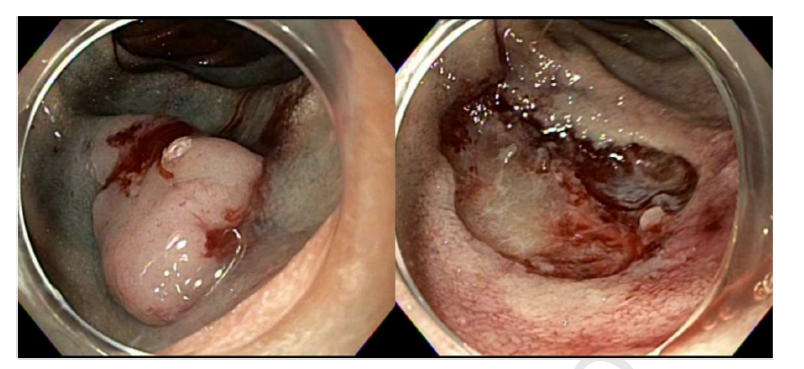 Online now in GIE’s Articles in Press: “Outcomes of cold snare endoscopic mucosal resection of nonampullary duodenal adenomas ≥1 cm: a multicenter study' by Natalie Wilson et al. giejournal.org/article/S0016-… @nataliejowilson @BilalMohammadMD