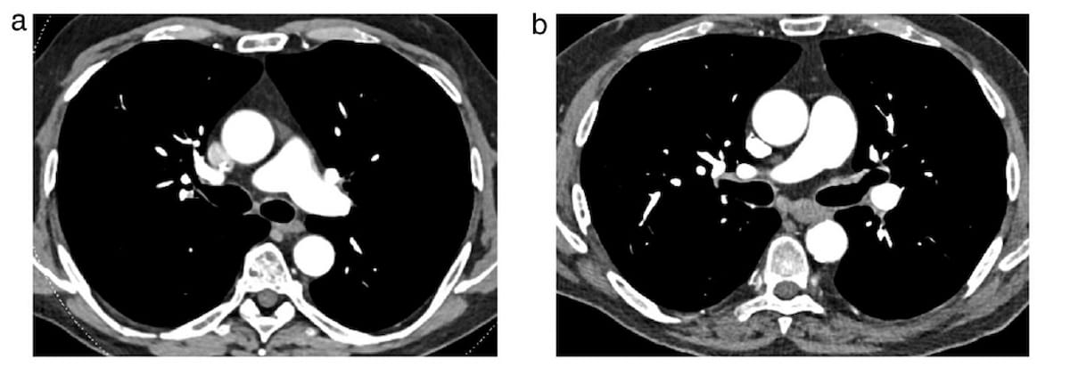 Study Reveals Benefits of Photon-Counting CT for Assessing Acute Pulmonary Embolism diagnosticimaging.com/view/study-pho… @ACRRFS @ACRYPS @RadiologyACR @ARRS_Radiology @RSNA @thoracicrad @RadiologyUSC @UofURadiology @UWRadiology @UCSFimaging @MayoRadiology @OHSURadiology #radiology #RadRes