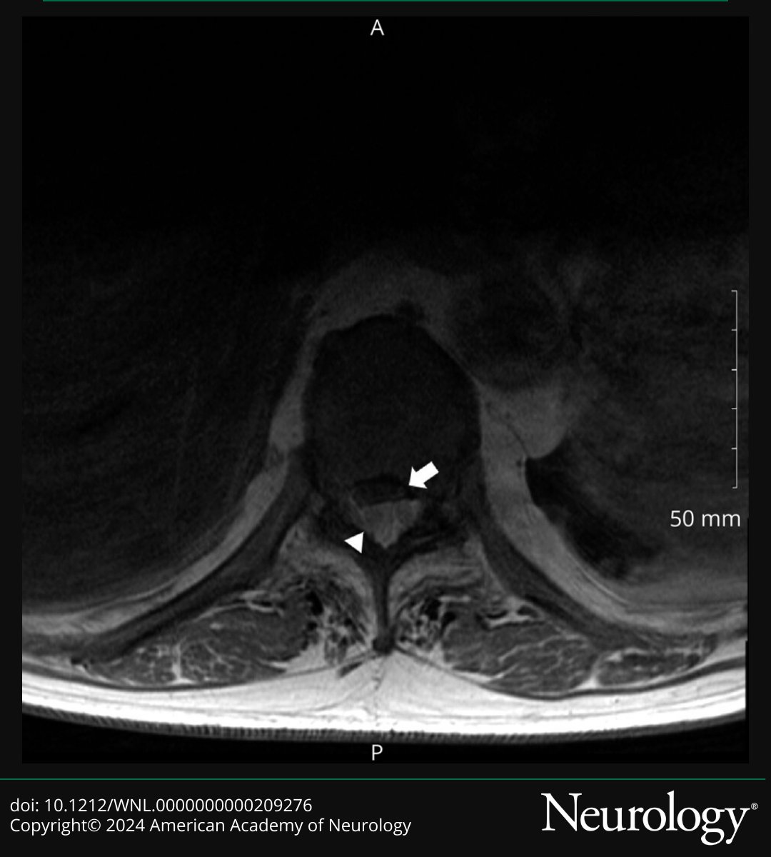 A 70-year-old man with myelodysplastic syndrome currently undergoing erythropoiesis stimulation therapy with luspatercept presented with worsening bilateral leg weakness and urinary retention. Read more: bit.ly/44hgzgs 

#NeurologyRF