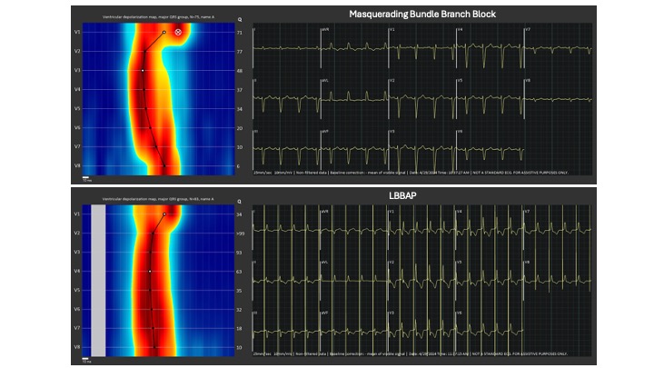 First cases using UHF-ECG at @HospitalLaFe for LBBAP. Nice case of masquerading bundle branch block perfectly depicted by UHF-ECG in a patient with paroxysmal AV block. It's so good to 'see' ventricular activation @curilakarol @MirekNavratil1 @gauravaupadhyay @DrRoderickTung
