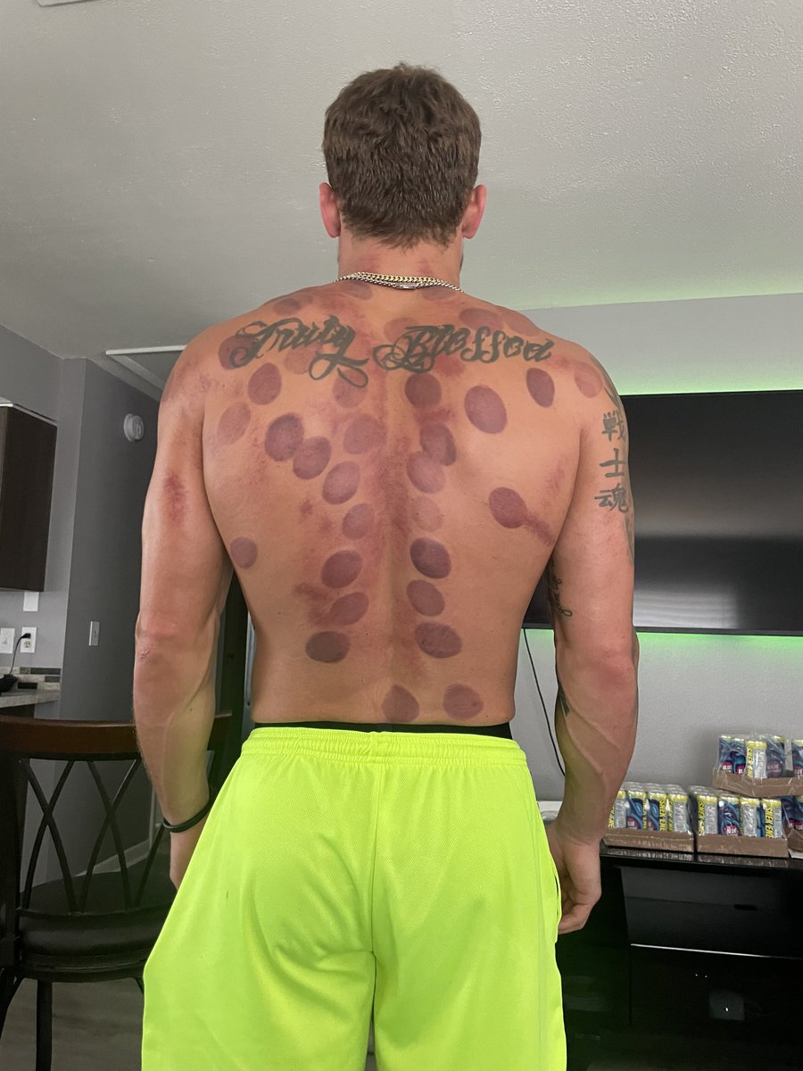MichaelHeckert's tweet photo. Fire Cupping Therapy + Scraping Today Was Life Changing😍
Never Felt So Good In My Life...
Heaven 🙌🏼
#FireCupping #SoftTissue #Feelsgood https://t.co/vbNq0xCSiL