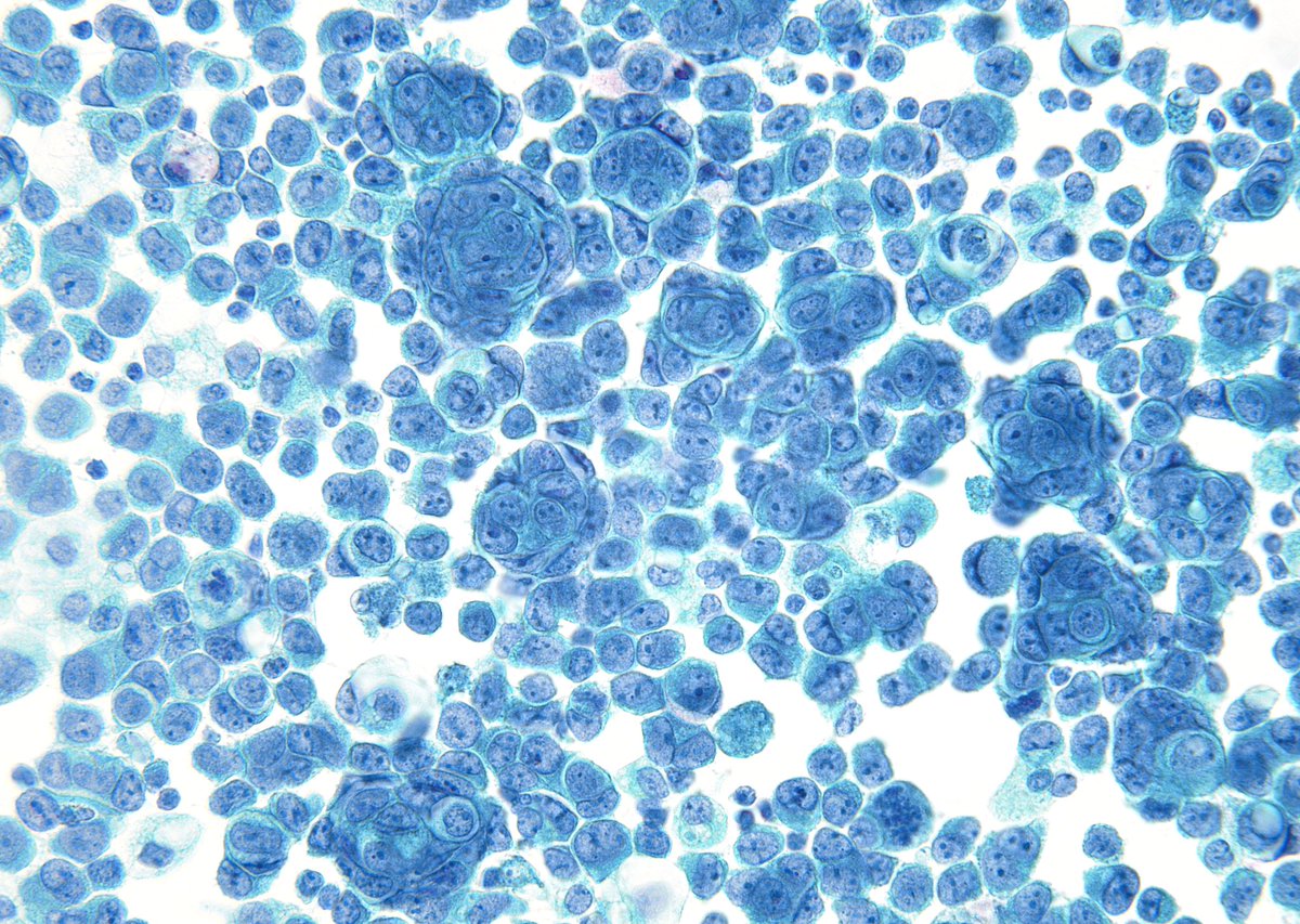 Wrapping around and around and around like a small cell carcinoma (SmCC) in serous cavity fluid but NOT a SmCC in this case. This patient had a known “Cholangiocarcinona” history.