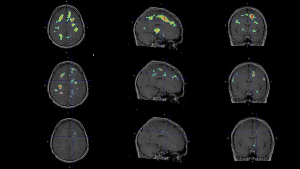 PET reveals ‘smoldering’ brain inflammation in patients treated for MS #radiology #PETimaging buff.ly/3QjCnTe