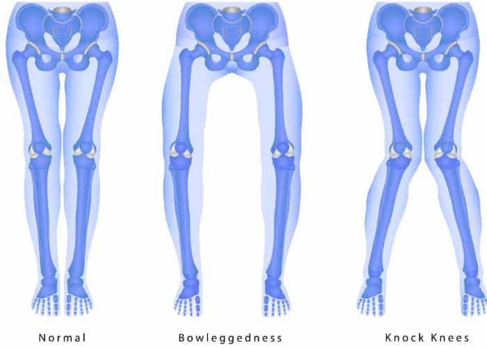 DrJeffPadalecki's tweet photo. Don't let lower extremity #malalignment hold you back! Recognize the signs: pain, swelling, stiffness &amp; inflammation. These symptoms could indicate an underlying issue that needs attention. Stay informed and take action for healthier legs! https://t.co/2CfaHAQJ0K  #orthotwitter https://t.co/HRDrS5hG0y