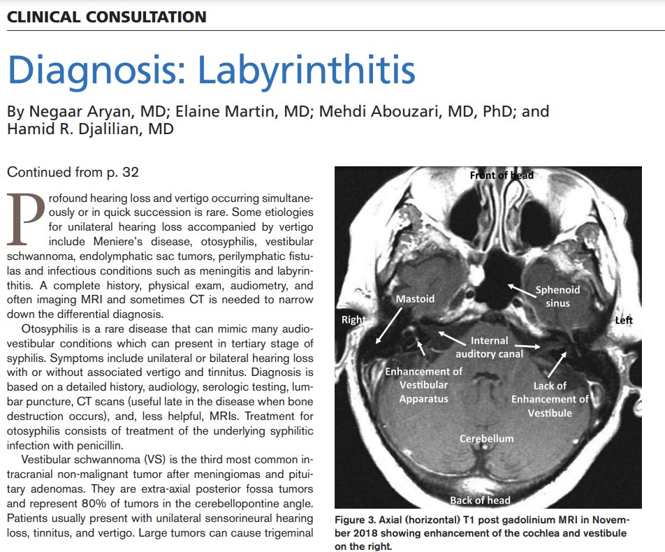 #ClinicalConsultation: Today's answer is labyrinthitis. Learn more here: ow.ly/2Xfl50RfR4N. #AuDpeeps #audiology