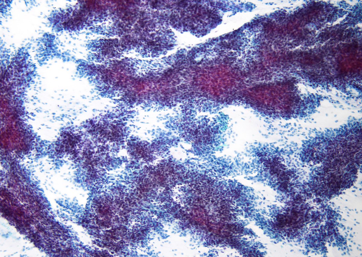 “Pleomorphic Adenomas” are often quite “cellular” and stroma can be exceedingly difficult to appreciate on Pap stain (not a reason to call them “atypical”). Parotid FNA