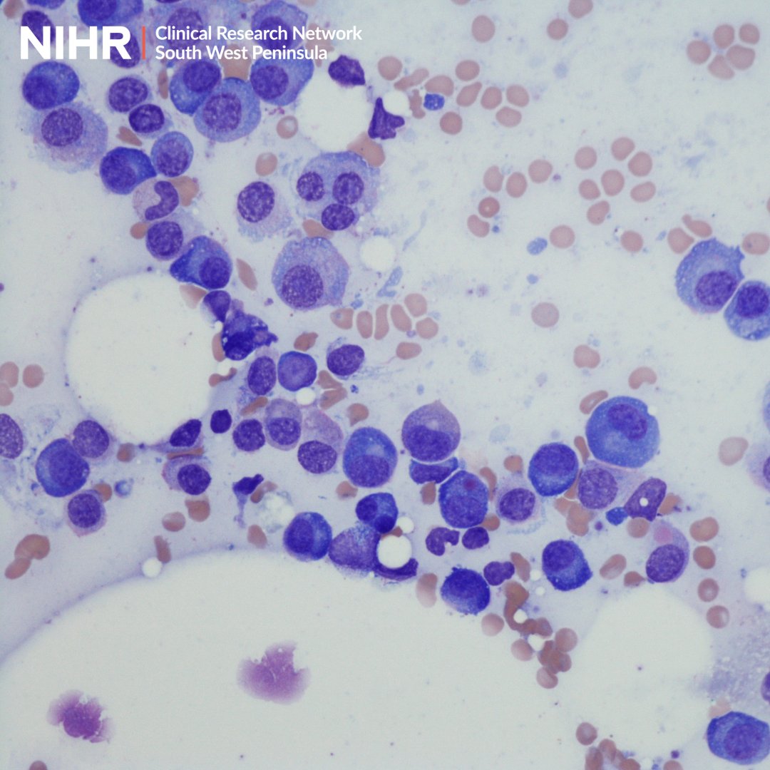 Congratulations to everyone @UHP_NHS @RDinUHP involved in recruiting the first UK participant in a trial investigating new treatments for multiple myeloma. local.nihr.ac.uk/news/first-uk-… #BePartOfResearch