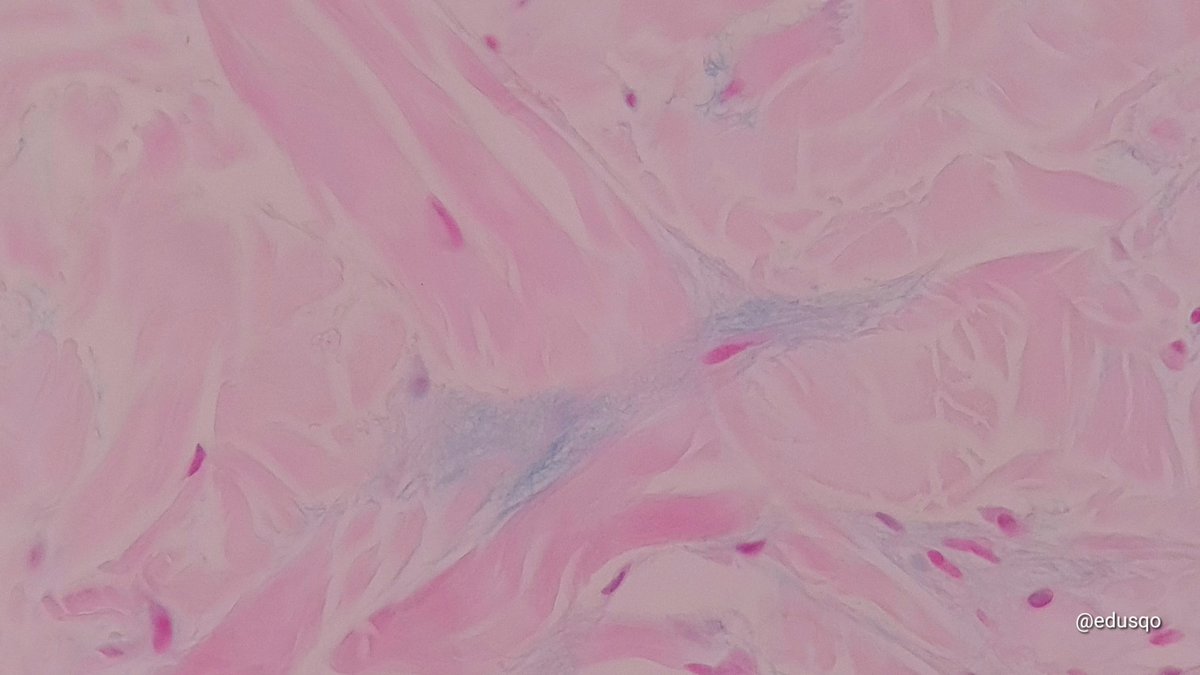 Remember dermal mucin can be seen in a variety of dermatitides besides lupus. Eczematous dermatitis with its mild spongiosis, hyper ortho/parakeratosis, and with some (mild) amount of dermal mucin, blue-gray between collagen bundles and with the beautiful alcian blue. #DermPath