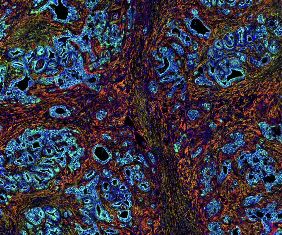 Congratulations to Bell and Yi on back to back @CD_AACR papers. Go @sastewartlab and @SitemanCenter aacrjournals.org/cancerdiscover…