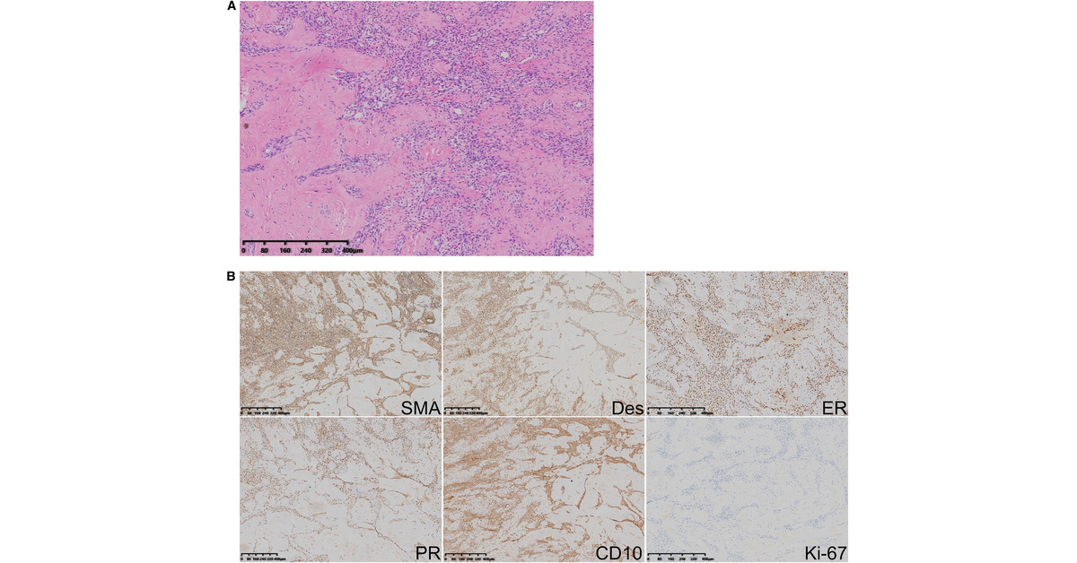 Dynamic Fluctuations of Metastatic Pulmonary Lesions 🔗 bit.ly/4aEoTte